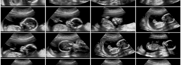 שאלות נפוצות על אולטרסאונד בהריון והתשובות  - תמונת המחשה