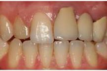 תמונה שצולמה להמחשת העבודות של ד"ר דולב ערן שיניים לפני הטיפול