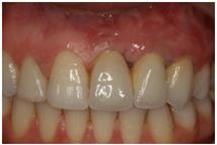 תמונה שצולמה להמחשת העבודות של ד"ר דולב ערן אחרי טיפול שיניים