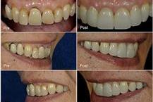 תמונה שצולמה להמחשת העבודות של ד"ר יורם קורנובסקי השתלות שיניים ממוחשבות