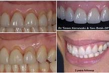 תמונה שצולמה להמחשת העבודות של ד"ר יורם קורנובסקי - 3 טיפולי שורש