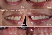 תמונה שצולמה להמחשת העבודות של ד"ר יורם קורנובסקי שירותי מעבדות שיניים