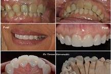 תמונה שצולמה להמחשת העבודות של ד"ר יורם קורנובסקי - 1 טיפולי שיניים מרוכזים ביום אחד