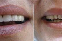 כתרים דיגיטאליים