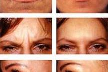 טיפול בקמטים - ד"ר זבלוצקי נדיה