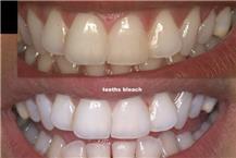 טיפולי הלבנת שיניים