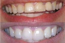 טיפולי שיניים אסתטיים