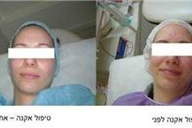 תמונה שצולמה להמחשת העבודות של טל קורן קוסמטיקה רפואית קוסמטיקאיות - טיפול אקנה