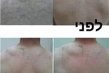 תמונה שצולמה להמחשת העבודות של אליעד לוי - מרכז קוסמטי הסרת שיער