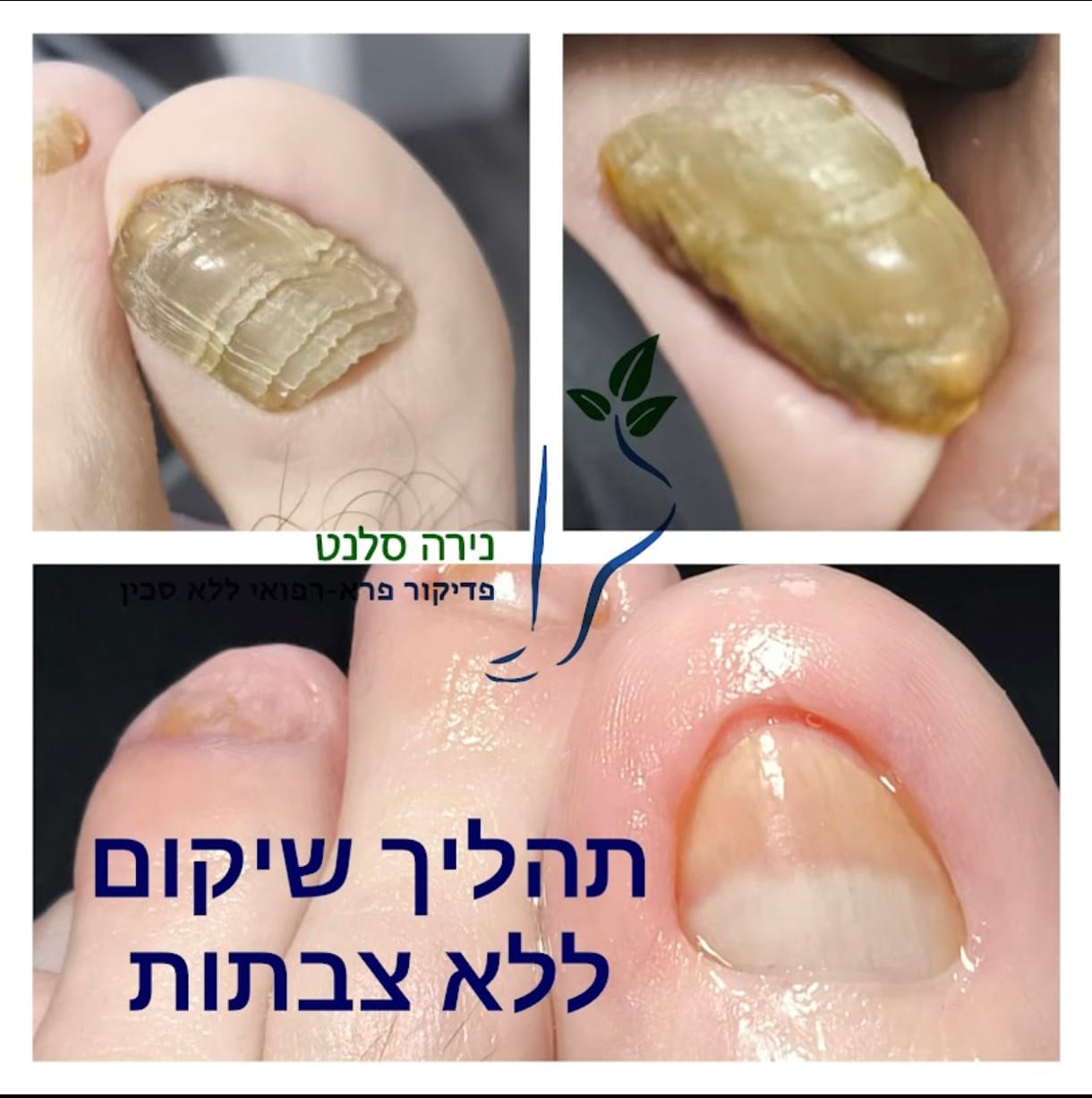 תמונה שצולמה להמחשת העבודות של נירה סלנט - פדיקור פארא-רפואי תמונה של נירה סלנט - פדיקור פארא-רפואי