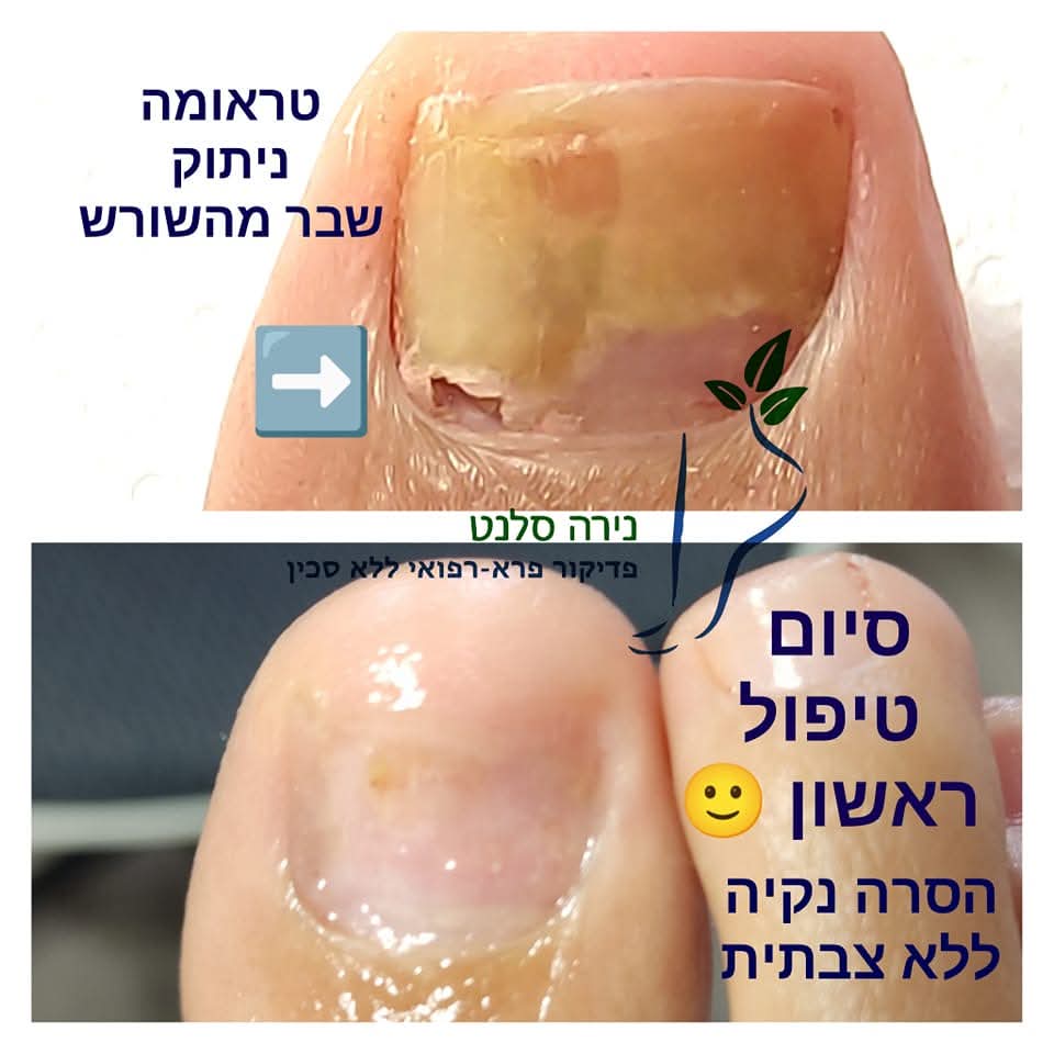 תמונה שצולמה להמחשת העבודות של נירה סלנט - פדיקור פארא-רפואי תמונה של נירה סלנט - פדיקור פארא-רפואי