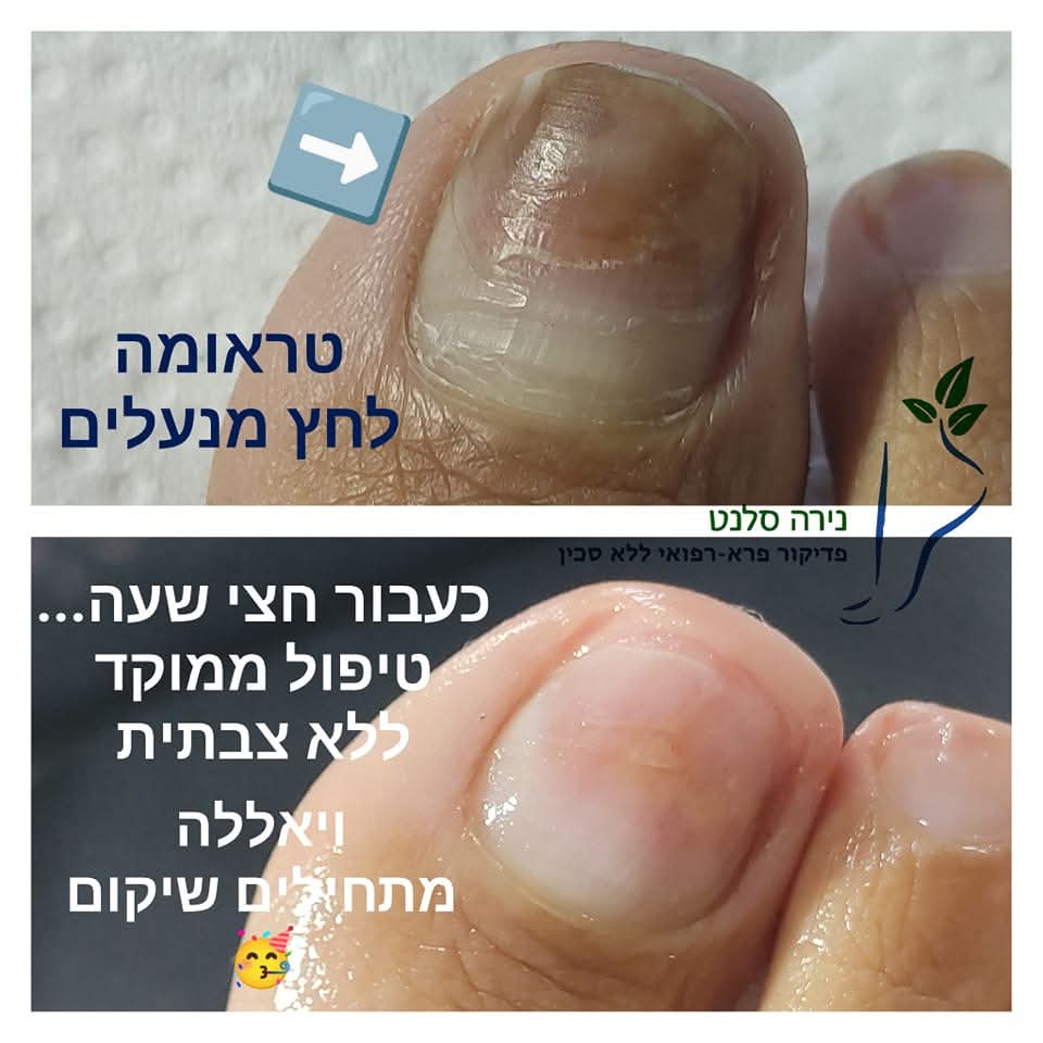 תמונה שצולמה להמחשת העבודות של נירה סלנט - פדיקור פארא-רפואי תמונה של נירה סלנט - פדיקור פארא-רפואי