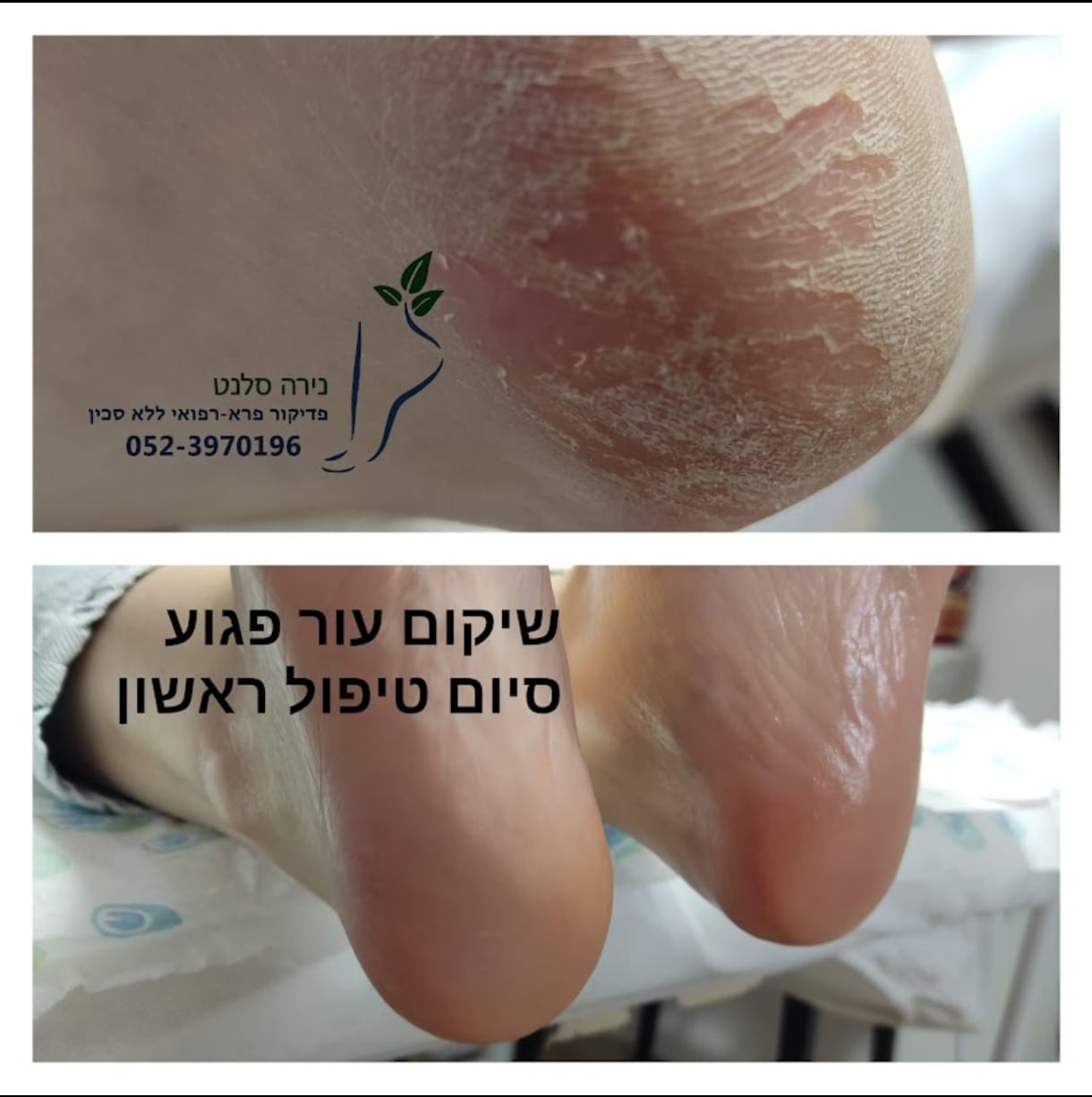 תמונה שצולמה להמחשת העבודות של נירה סלנט - פדיקור פארא-רפואי תמונה של נירה סלנט - פדיקור פארא-רפואי