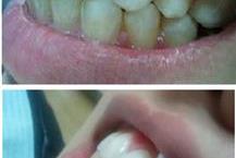 תמונה שצולמה להמחשת העבודות של אומני שן מעבדת שיניים