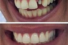 תמונה שצולמה להמחשת העבודות של אומני שן התאמת כתרים לשן