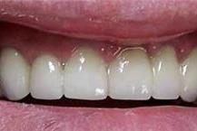 שיניים לאחר טיפול