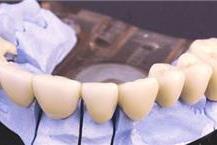 התקנת גשרים מחרסינה