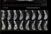 צילום ציפלומטרי דיגיטלי