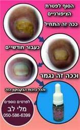 תמונה שצולמה להמחשת העבודות של מלי לב - פדיקור רפואי - 2 תמונה של מלי לב - פדיקור רפואי