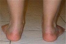 הקלה על בעיות בכף הרגל