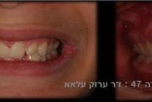 תמונה שצולמה להמחשת העבודות של מרפאת שיניים נווה שאנן- ד"ר ערוק שיקום על גבי שתלים