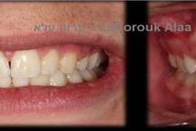 תמונה שצולמה להמחשת העבודות של מרפאת שיניים נווה שאנן- ד"ר ערוק טיפולי שיננית