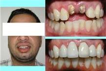 תמונה שצולמה להמחשת העבודות של מרפאת שיניים נווה שאנן- ד"ר ערוק מרפאות שיניים