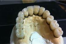 שיקום על גבי שתלים