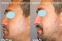 כירורגיה פלסטית של האף