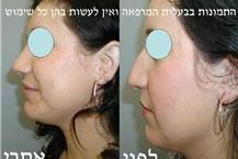 רופאת אף אוזן גרון המבצעת ניתוחי אף פלסטיים