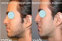 ד"ר שושנה קרמר - מומחית בניתוחי אף