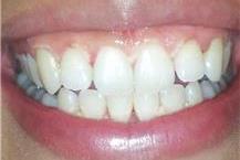 תמונה שצולמה להמחשת העבודות של ד"ר חורי ניזאר - 3 שיניים אחרי הלבנה