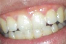 תמונה שצולמה להמחשת העבודות של ד"ר חורי ניזאר - 1 שיניים לפני הלבנה