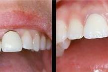 טיפול עם כתרי זרקוניה