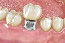 טיפולי השתלות שיניים