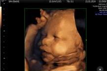 מעקב היריון