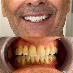 תמונה שצולמה להמחשת העבודות של ד"ר עומרי מועתסם רופא שיניים תמונה של ד"ר עומרי מועתסם רופא שיניים