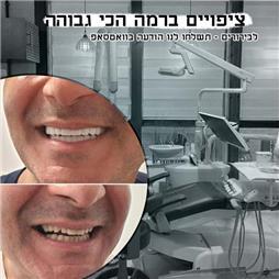 תמונה שצולמה להמחשת העבודות של ד"ר עומרי מועתסם רופא שיניים תמונה של ד"ר עומרי מועתסם רופא שיניים