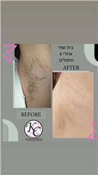 תמונה שצולמה להמחשת העבודות של הסרת שיער בלייזר קר קלודיה כהן תמונה של הסרת שיער בלייזר קר קלודיה כהן