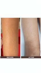 תמונה שצולמה להמחשת העבודות של הסרת שיער בלייזר קר קלודיה כהן תמונה של הסרת שיער בלייזר קר קלודיה כהן