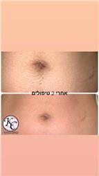 תמונה שצולמה להמחשת העבודות של הסרת שיער בלייזר קר קלודיה כהן תמונה של הסרת שיער בלייזר קר קלודיה כהן