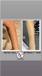 תמונה שצולמה להמחשת העבודות של הסרת שיער בלייזר קר קלודיה כהן תמונה של הסרת שיער בלייזר קר קלודיה כהן