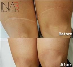 תמונה שצולמה להמחשת העבודות של אינה בן נון - מיקרונידלינג ומיקרופיגמנטציה אסתטית ושיקומית תמונה של אינה בן נון - מיקרונידלינג ומיקרופיגמנטציה אסתטית ושיקומית