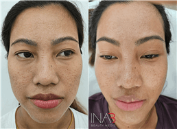 תמונה שצולמה להמחשת העבודות של אינה בן נון - מיקרונידלינג ומיקרופיגמנטציה אסתטית ושיקומית תמונה של אינה בן נון - מיקרונידלינג ומיקרופיגמנטציה אסתטית ושיקומית