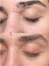 תמונה שצולמה להמחשת העבודות של אינה בן נון - מיקרונידלינג ומיקרופיגמנטציה אסתטית ושיקומית תמונה של אינה בן נון - מיקרונידלינג ומיקרופיגמנטציה אסתטית ושיקומית