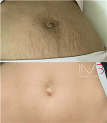 תמונה שצולמה להמחשת העבודות של אינה בן נון - מיקרונידלינג ומיקרופיגמנטציה אסתטית ושיקומית תמונה של אינה בן נון - מיקרונידלינג ומיקרופיגמנטציה אסתטית ושיקומית