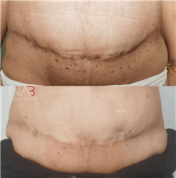 תמונה של אינה בן נון - מיקרונידלינג ומיקרופיגמנטציה אסתטית ושיקומית