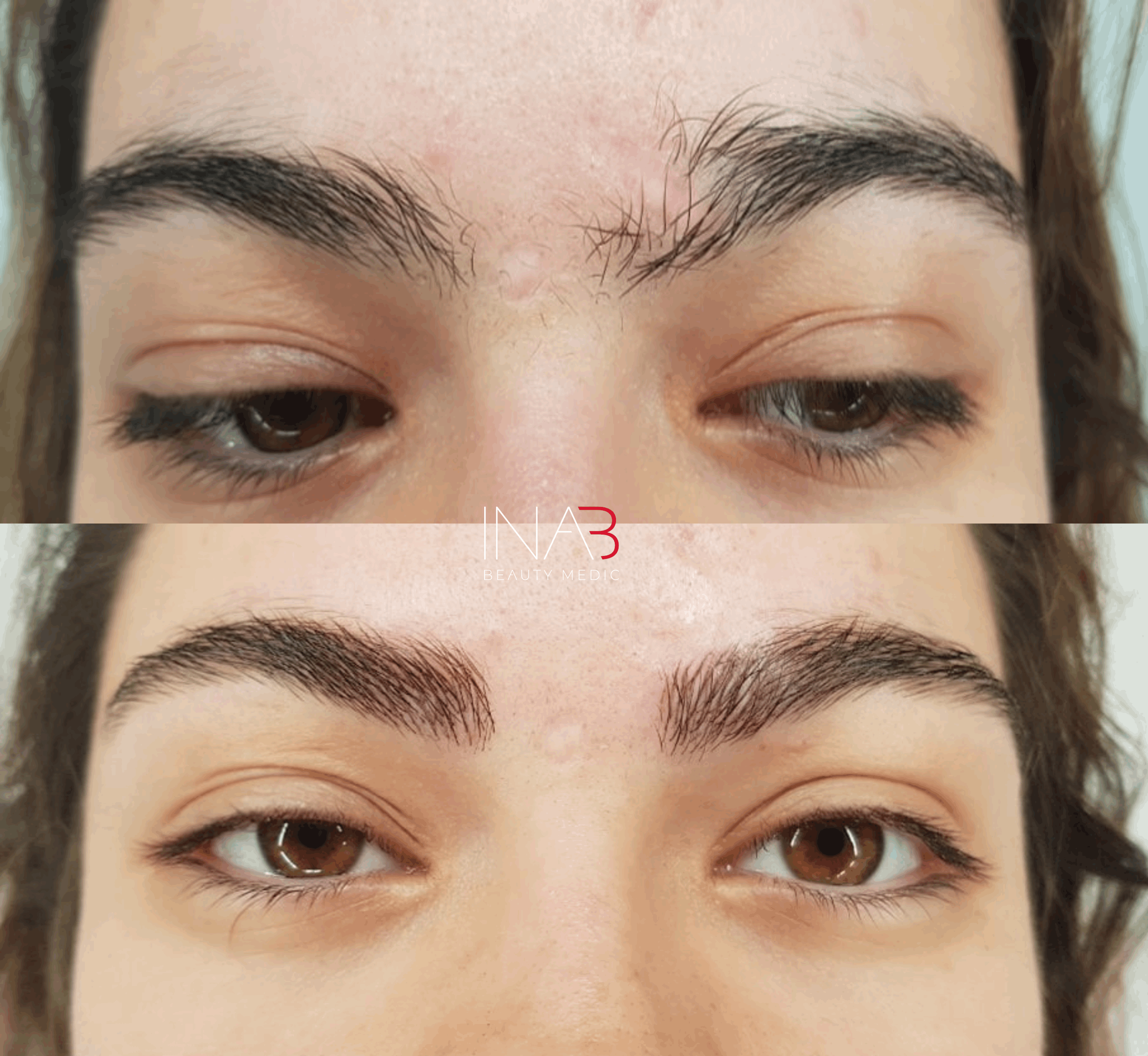 תמונה שצולמה להמחשת העבודות של אינה בן נון - מיקרונידלינג ומיקרופיגמנטציה אסתטית ושיקומית תמונה של אינה בן נון - מיקרונידלינג ומיקרופיגמנטציה אסתטית ושיקומית