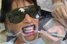 הלבנת שיניים